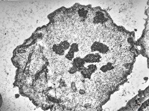 M,62y. | mitosis - plasmocytoma